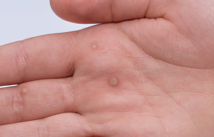 Effective Strategies for Warding Off Warts